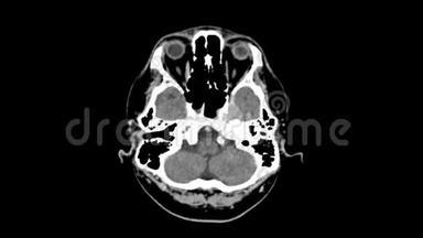 头顶视上脑CT扫描